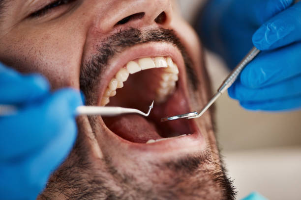 Best Chipped Tooth Repair Near Me  in Siesta Key, FL